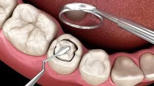 الحشوات التجميلية والفينيرز