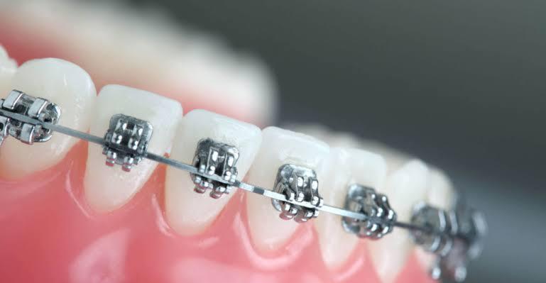 Orthodontic treatment in Heliopolis Orthodontic treatment in Heliopolis Cairo