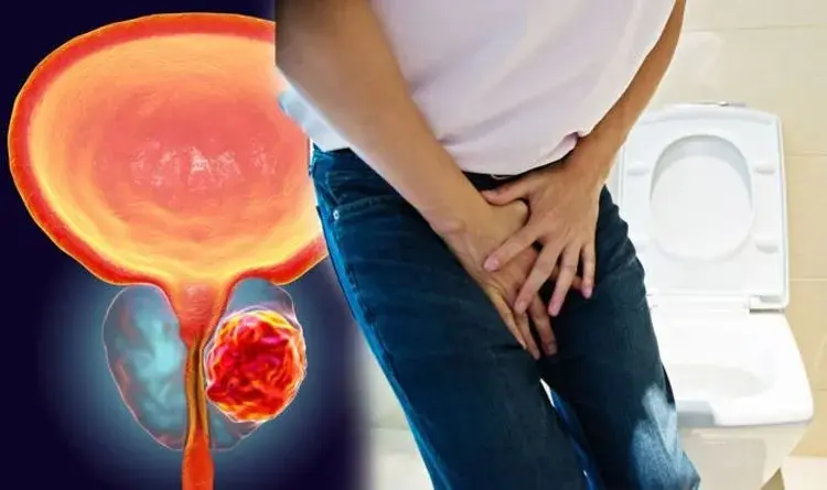تضخم البروستاتا ومشكلات التبول