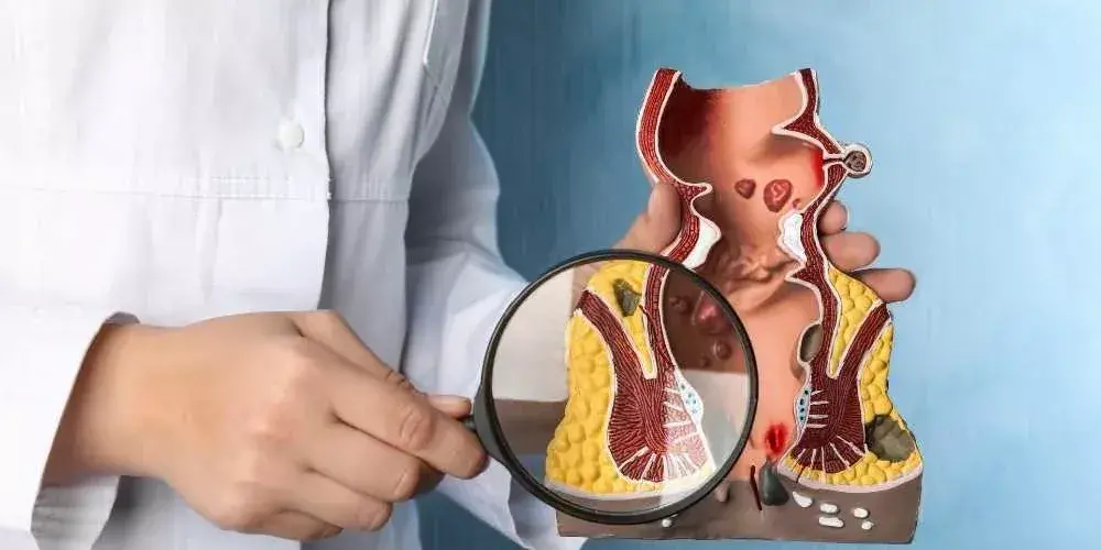 علاج البواسير في طوخ
