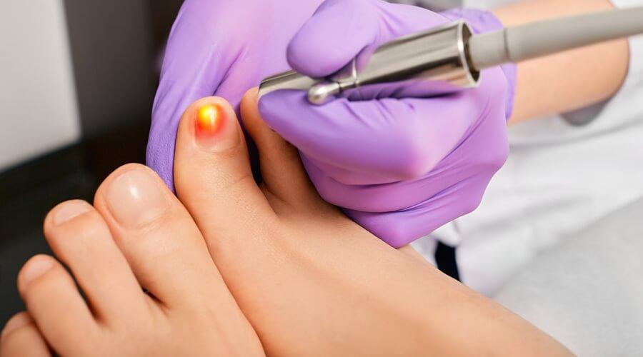 علاج فطريات الأظافر بالليزر في المعادي 
