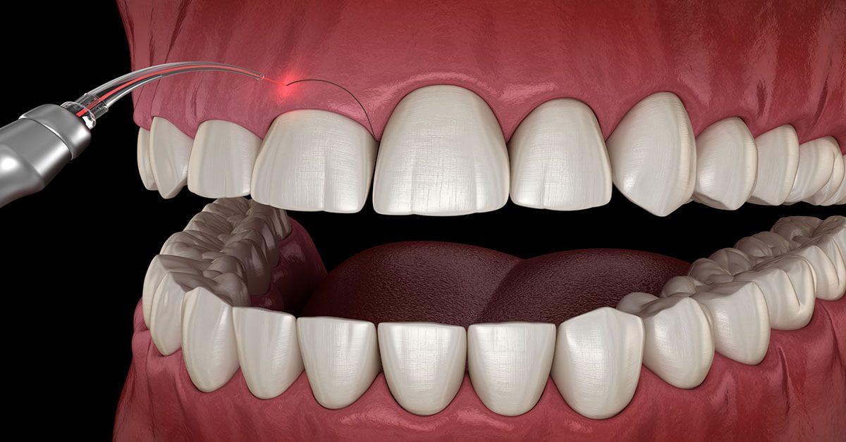 Gum treatment and oral infection treatment with laser in Downtown Cairo