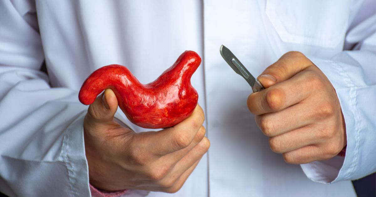 Gastric sleeve surgery in Qalyubia with Dr. Mohamed Mansour