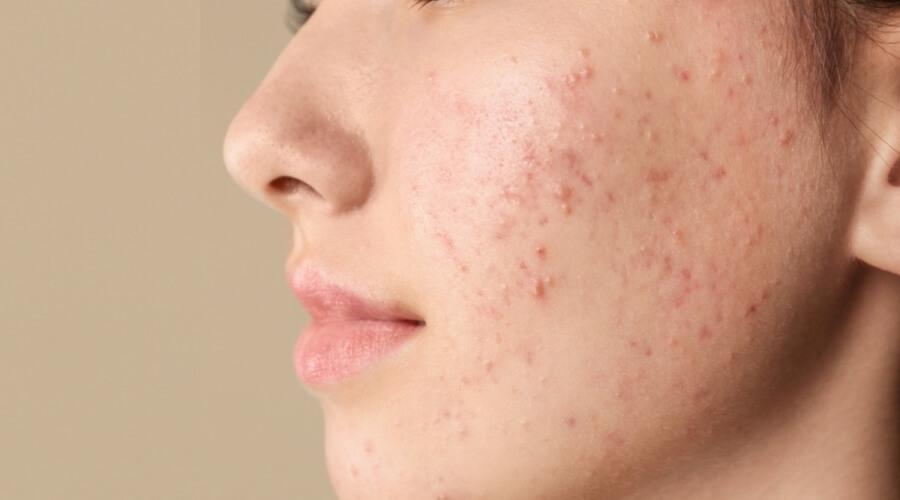 Dermatologist in Maadi - Acne Treatment