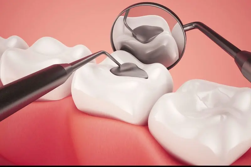 الحشوات التجميلية للأسنان