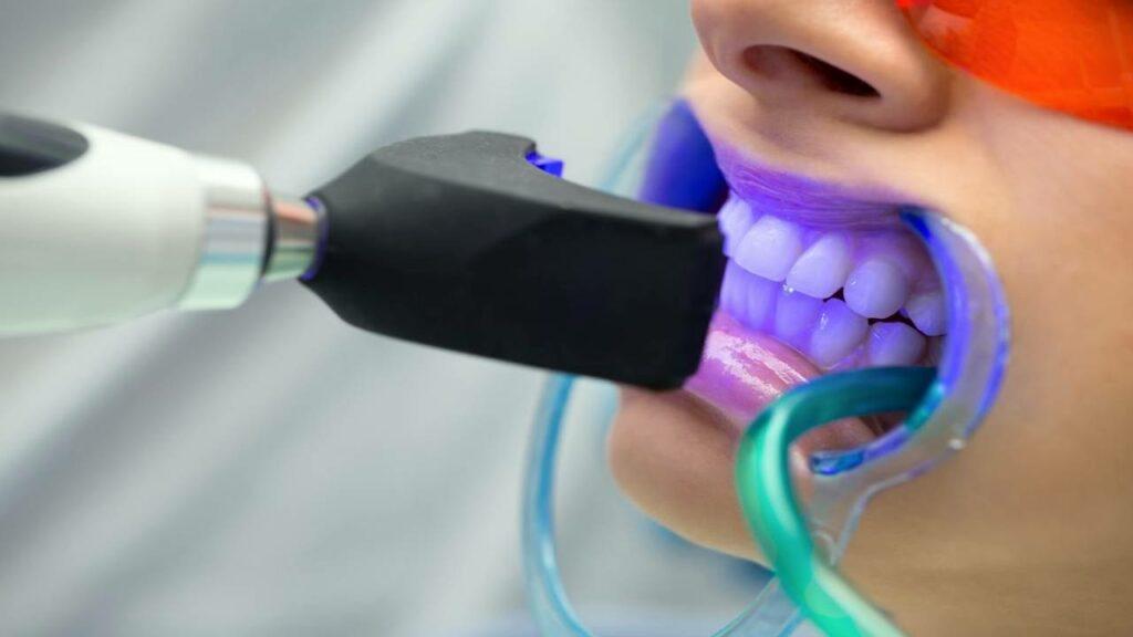 Laser teeth whitening in Cairo for a brighter and more attractive smile