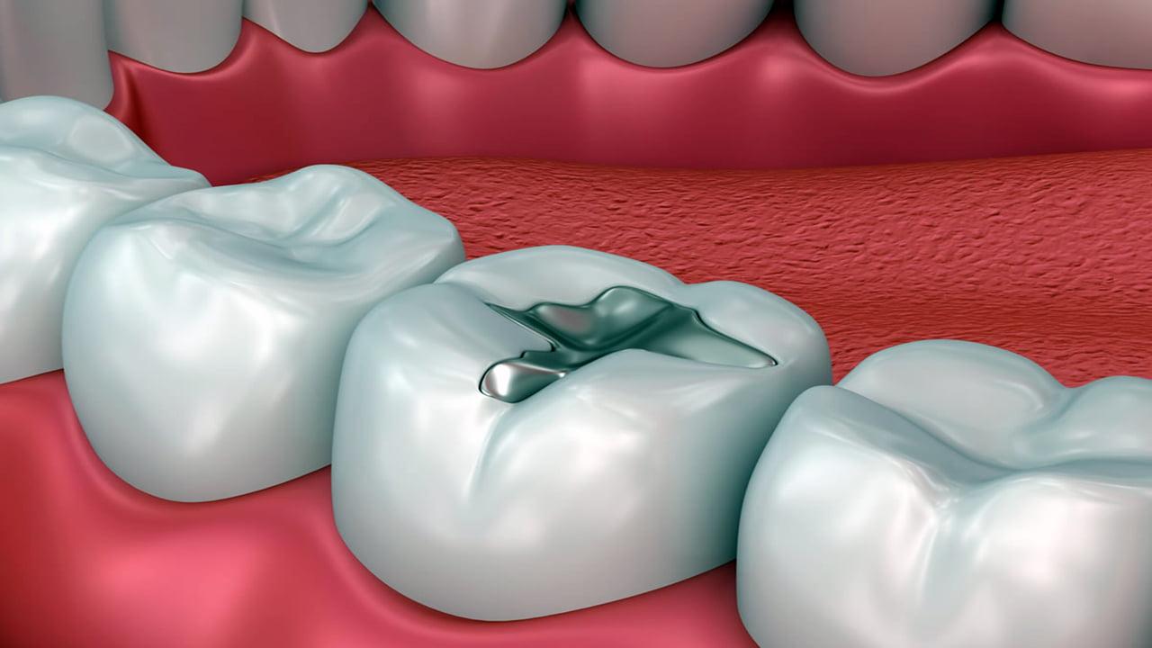 Cosmetic dental fillings for treating tooth decay in Downtown Cairo