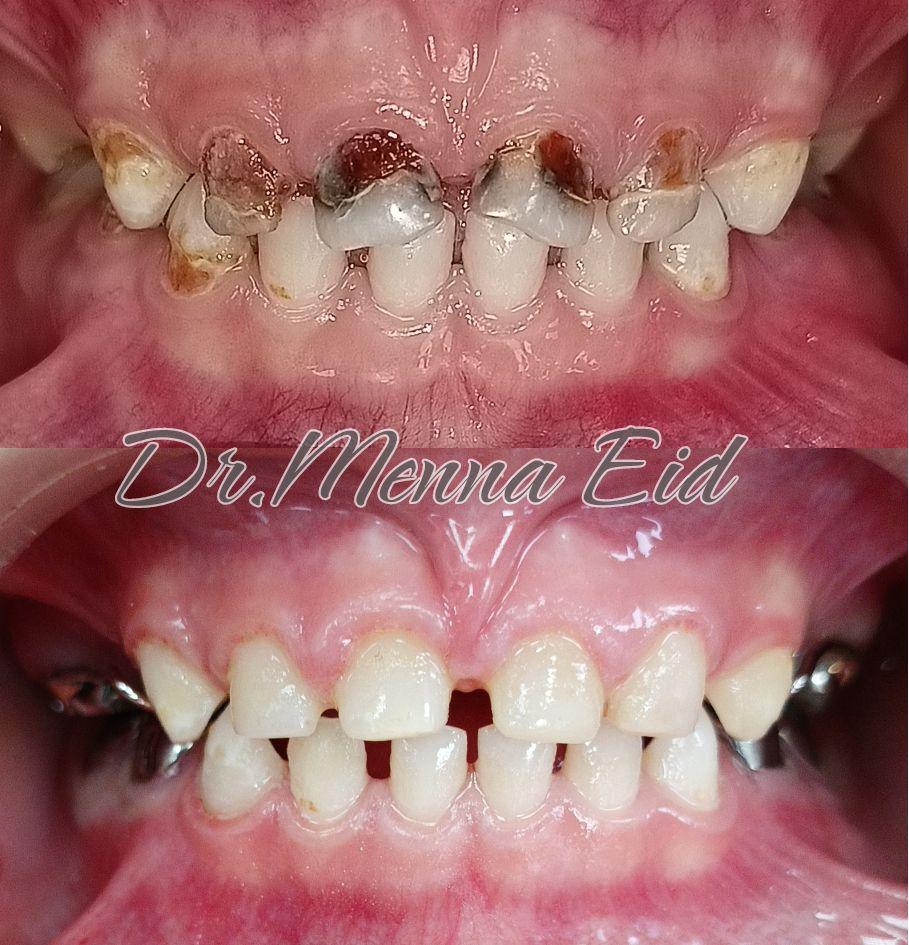 قبل وبعد - حالة أسنان أطفال 2