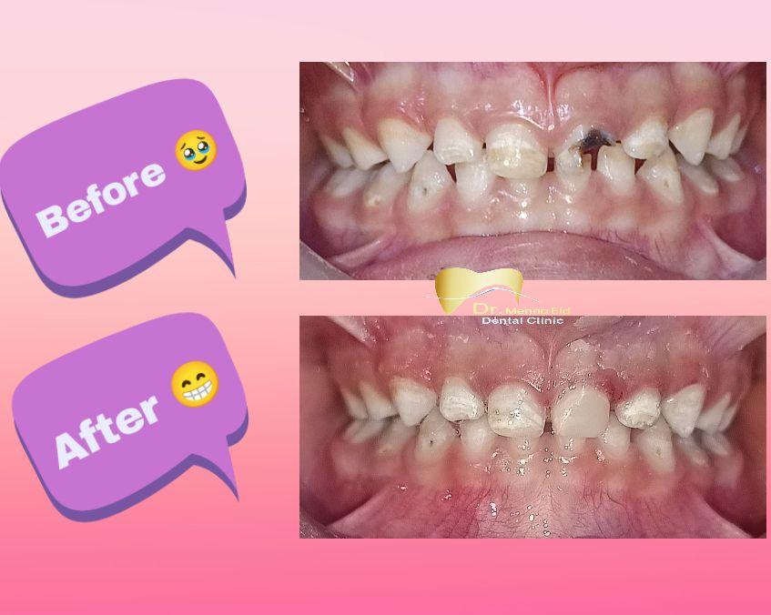قبل وبعد - حالة أسنان أطفال 3