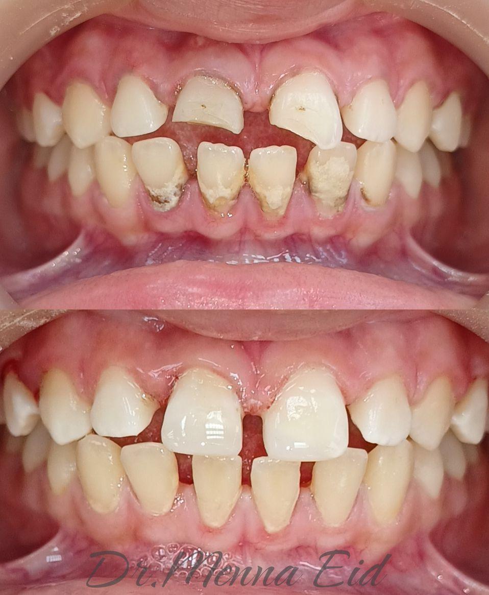 قبل وبعد - حالة أسنان أطفال 4