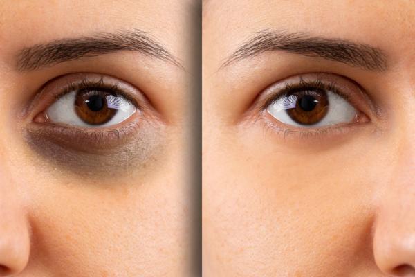 علاج الهالات السوداء وشد الجلد حول العينين