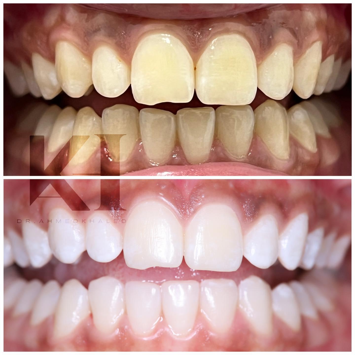 تبييض الأسنان بالليزر