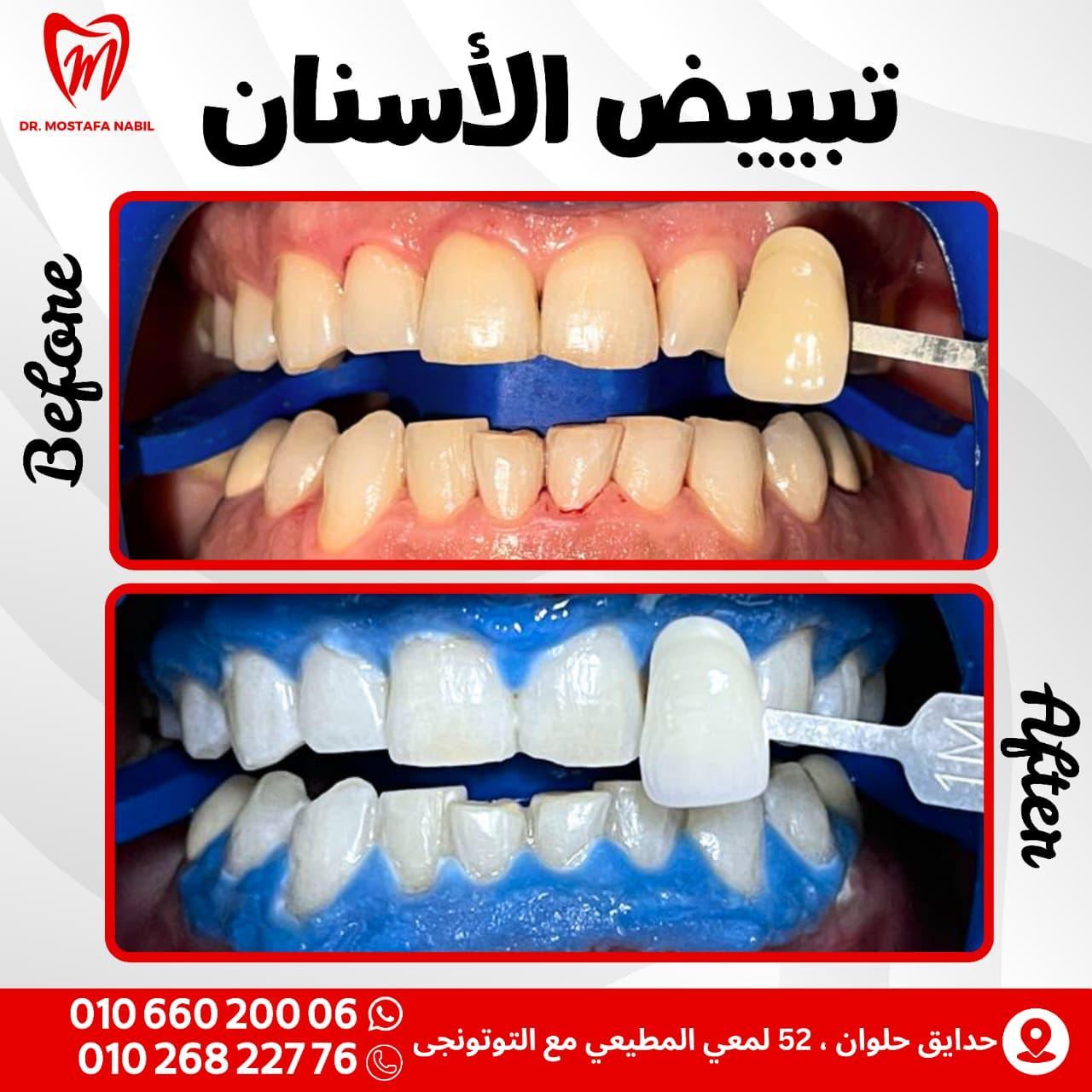 Teeth Whitening Teeth Whitening