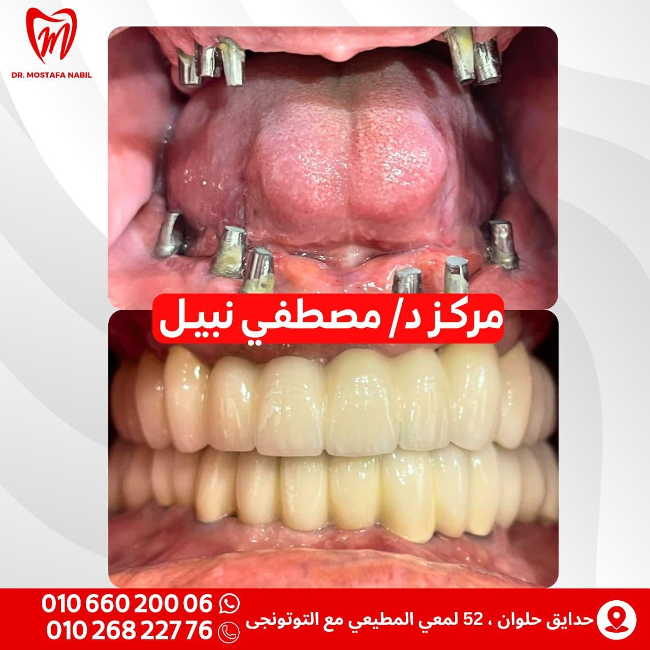 Dental Prosthetics Dental Prosthetics