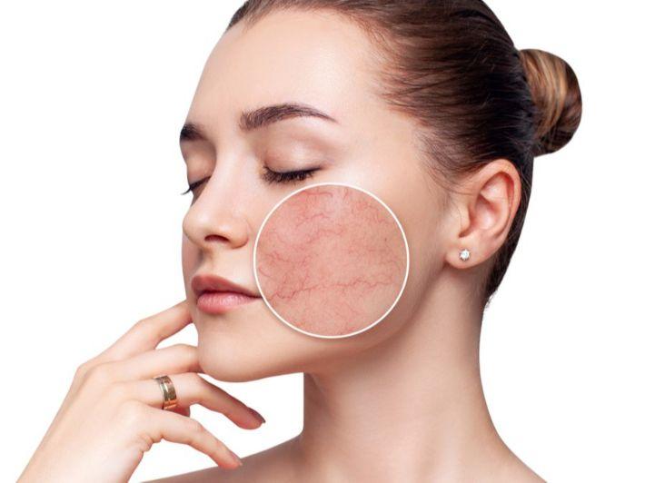 علاج البشرة الحساسة والتهيجات الجلدية