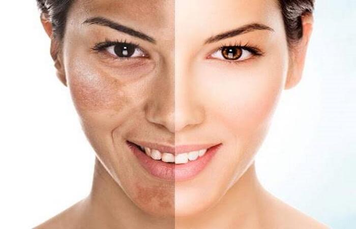 علاج التصبغات