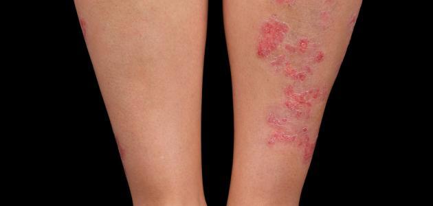 السيطرة على الإكزيما والصدفية بمختلف أنواعها