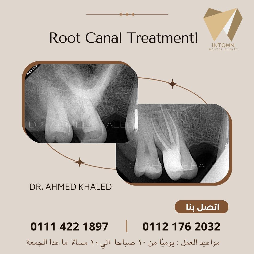 علاج العصب جذور الاسنان