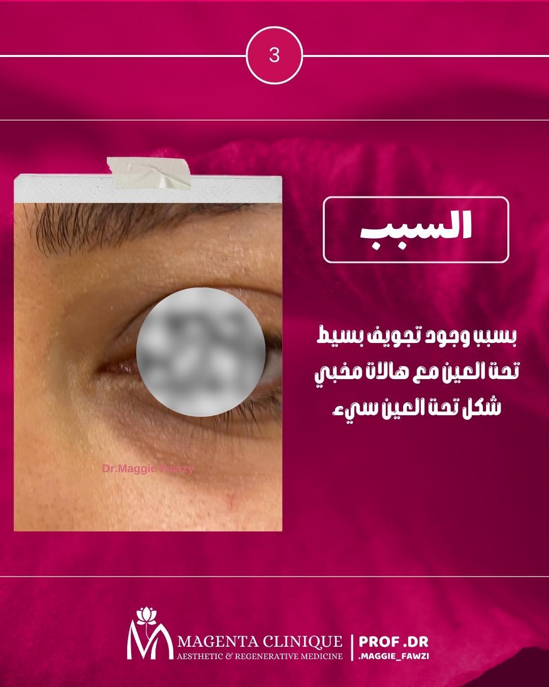 علاج مشاكل تحت العين
