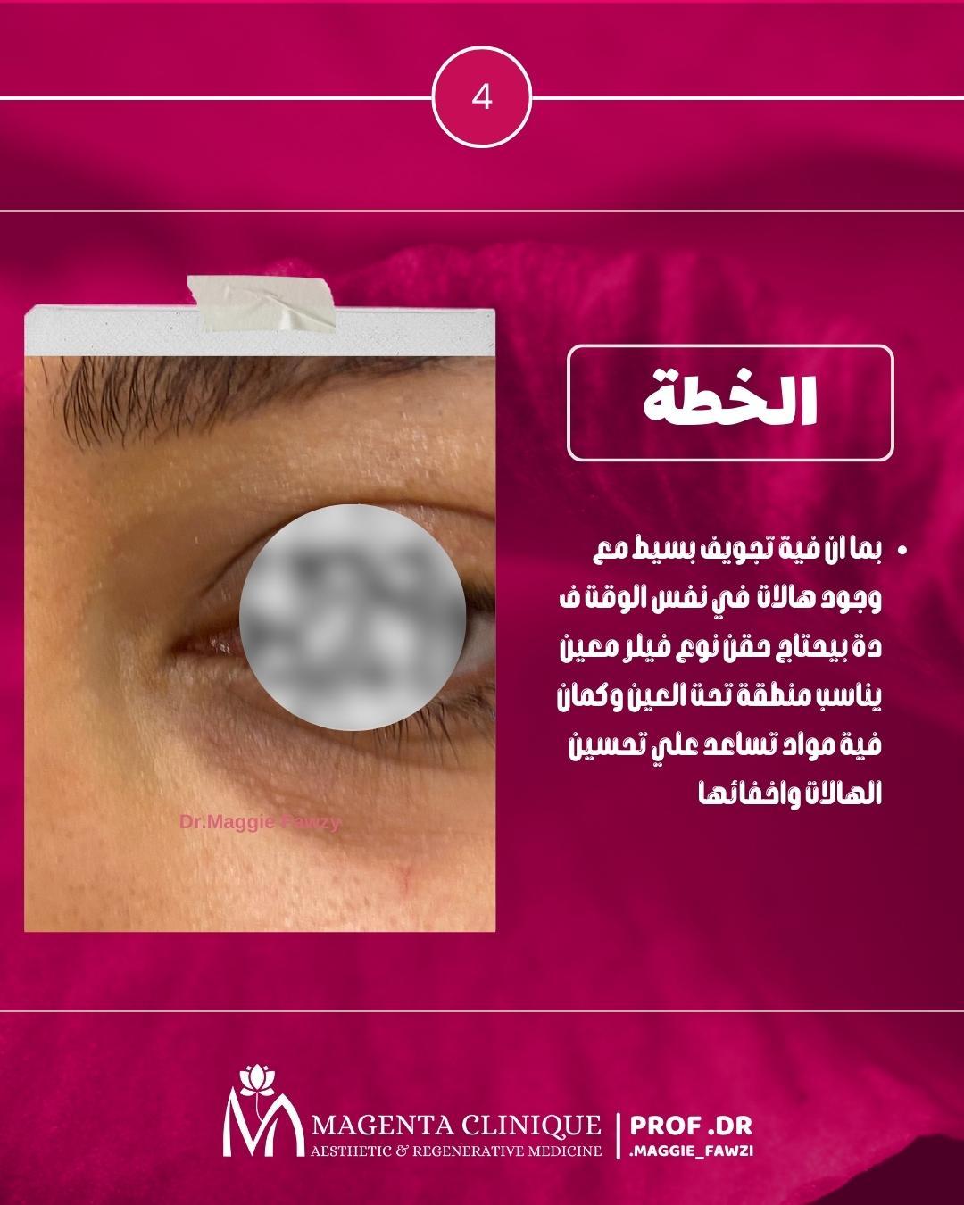 خطه علاج مشاكل تحت العين
